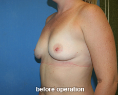 plastic-surgery-breast-augmentation